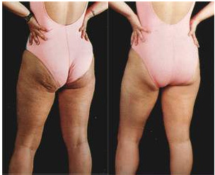 cellulite e buccia d arancia prima e dopo