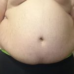 La Liposuzione, una soluzione chirurgica per migliorare l'estetica